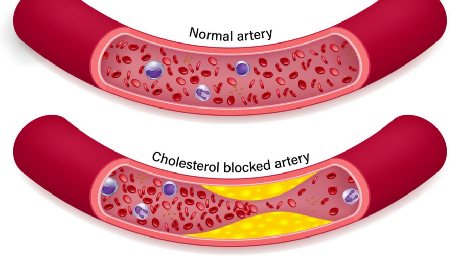 good and bad cholesterol