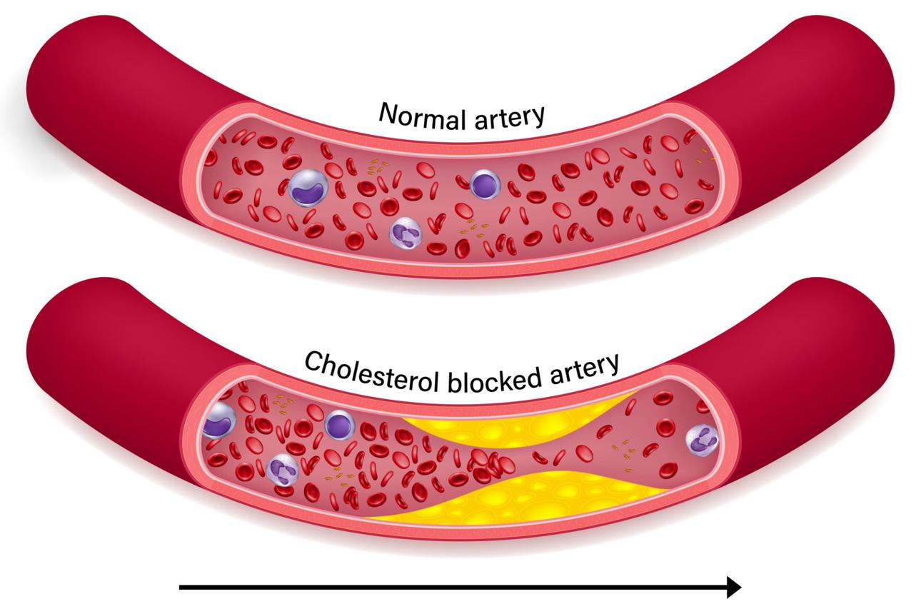 good and bad cholesterol
